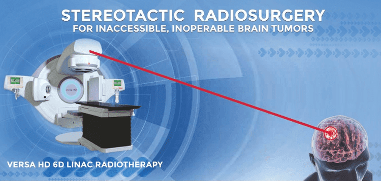 Stereotactic Radiosurgery (SRS): Non-Surgical Treatment For Brain Tumors