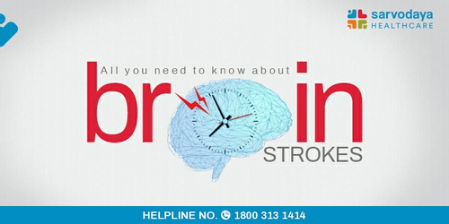 All You Need To Know About Brain Strokes