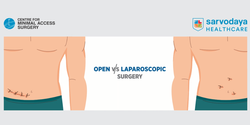 Open Surgery V/s Laparoscopic Surgery: Which Is Better?