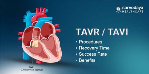 TAVI Procedure: Benefits, Risks, Treatment & Recovery